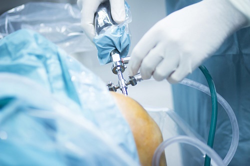 Arthroscopic Surgeries Lifecare Polyclinic Dr Ashish Assudani Knee Replacement Surgeon